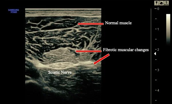 Nerve Entrapment — Dr. Efren Caballes, D.O.
